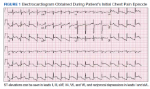 Electrocardiogram Obtained During Patient’s Initial Chest Pain Episode