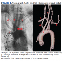 Angiograph and CT Reconstruction