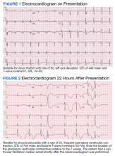 Electrocardiogram on Presentation and Electrocardiogram 22 Hours After Presentation figures