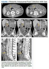 Periaortic Aneurysmal Fluid Collection With Gas Figure