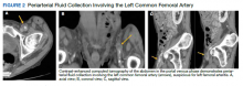 Periarterial Fluid Collection Involving the Left Common Femoral Artery figure