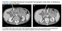 Contrast-Enhanced Computed Tomography Axial View of Abdomen in Portal Venous Phase figure