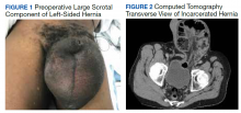 Preoperative Large Scrotal Component of Left-Sided Hernia and Computed Tomography Transverse View of Incarcerated Hernia