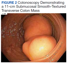 Colonoscopy Demonstrating a 11-cm Submucosal Smooth-Textured Transverse Colon Mass