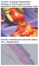 Surgical Intraoperative Findings of a Soft Lesion on the Mesenteric Side of the Transverse Colon and Hematoxylin and Eosin Stains, 100 × Magnification