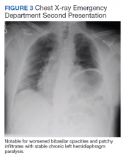 Chest X-ray Emergency Department Second Presentation figure