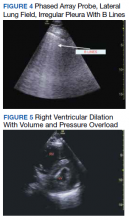 Phased Array Probe, Lateral Lung Field, Irregular Pleura With B Lines and Right Ventricular Dilation With Volume and Pressure Overload figures