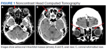 Noncontrast Head Computed Tomography figure