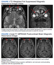 T2-Weighted Fat Suppressed Magnetic Resonance Image Orbits and Axial T1 MPRAGE Postcontrast Brain Magnetic Resonance Image