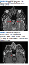 Axial T2 Weighted Fat- Suppressed Magnetic Resonance Image Orbits and Axial T1-Weighted Postcontrast Fat-Suppressed Magnetic Resonance Image Orbits Showing Normal Appearing Cavernous Sinus