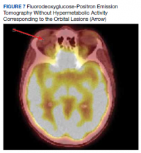 Fluorodeoxyglucose-Positron Emission Tomography Without Hypermetabolic Activity Corresponding to the Orbital Lesions (Arrow