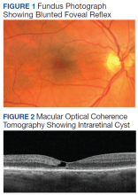 Fundus Photograph Showing Blunted Foveal Reflex  and Macular Optical Coherence Tomography Showing Intraretinal Cyst