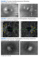 Fundus Autofluorescence Showing Hyperreflective Crescent, Optical Coherence Tomography Angiography Showing Abnormal Dilation, Fluorescein Angiography Showing Latephase Telangiectatic Vessel Leakage