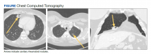 Chest Computed Tomography