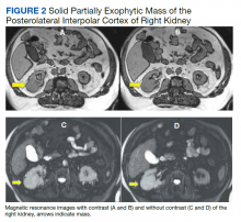 Solid Partially Exophytic Mass of the Posterolateral Interpolar Cortex of Right Kidney