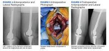 Lateral Radiographs and Intraoperative Photograph