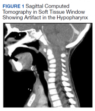 Sagittal Computed Tomography in Soft Tissue Window Showing Artifact in the Hypopharynx