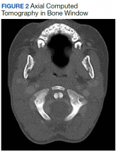 Axial Computed Tomography in Bone Window