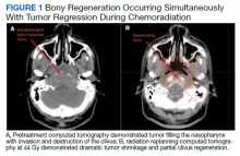 Bony Regeneration Occurring Simultaneously With Tumor Regression During Chemoradiation