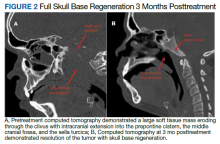 Full Skull Base Regeneration 3 Months Posttreatment