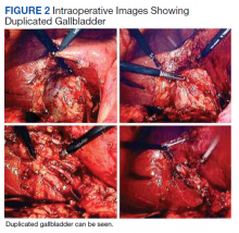 Intraoperative Images Showing Duplicated Gallbladder