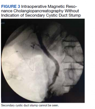 Intraoperative Magnetic Resonance Cholangiopancreatography Without Indication of Secondary Cystic Duct Stump