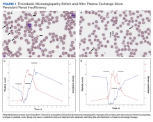 Thrombotic Microangiopathy Before and After Plasma Exchange Show Persistent Renal Insufficiency