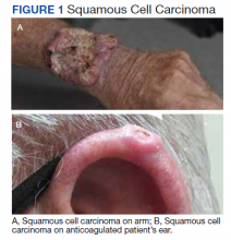 A, Squamous cell carcinoma on arm; B, Squamous cell carcinoma on anticoagulated patient’s ear.