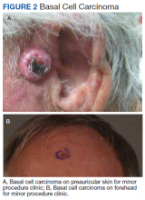 A, Basal cell carcinoma on preauricular skin for minor procedure clinic; B, Basal cell carcinoma on forehead for minor procedure clinic.