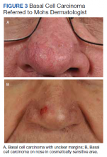 A, Basal cell carcinoma with unclear margins; B, Basal cell carcinoma on nose in cosmetically sensitive area.