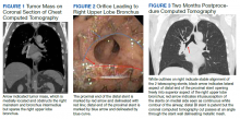 Tumor Mass on Coronal Section of Chest Computed Tomography, Orifice Leading to Right Upper Lobe Bronchus, Two Months Postprocedure Computed Tomography