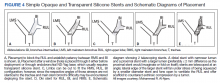 Simple Opaque and Transparent Silicone Stents and Schematic Diagrams of Placement