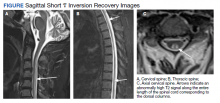 Sagittal Short τ Inversion Recovery Images