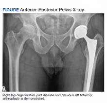 Anterior-Posterior Pelvis X-ray