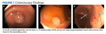 Colonoscopy Findings