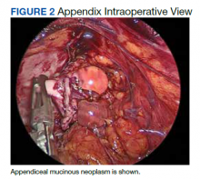 Appendix Intraoperative View