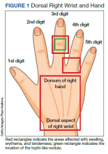 Dorsal Right Wrist and Hand