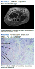 Contrast Magnetic Resonance Image and Hematoxylin and Eosin Stain ×40 Magnification