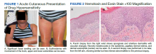 Acute Cutaneous Presentation of Drug Hypersensitivity