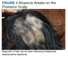 Alopecia Areata on the Posterior Scalp