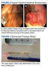 Upper Gastrointestinal Endoscopy and Extracted Foreign Body