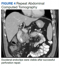 Repeat Abdominal Computed Tomography