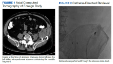 Axial Computed Tomography of Foreign Body, Catheter-Directed Retrieval