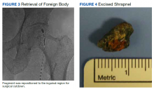 Retrieval of Foreign Body, Excised Shrapnel