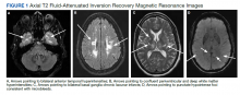 Axial T2 Fluid-Attenuated Inversion Recovery Magnetic Resonance Images