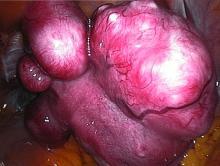 Uterine fibroids