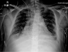 Figure 1. Radiography immediately after surgery showed cardiac tamponade, which led to repeat sternotomy with mediastinal washout.