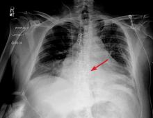 Figure 2. On postoperative day 4, midline sternal lucency and a slight leftward deviation of the second-from-the-lowest sternal wire—early signs of dehiscence—resulted in mild loss of alignment.