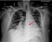 Figure 3. On postoperative day 5, the widely separated sternal wires indicated advanced sternal dehiscence.