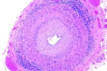 A micrograph of giant cell arteritis with hematoxylin and eosin staining.